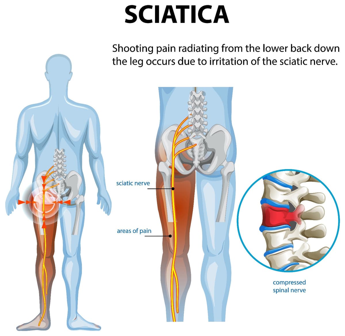 How Long Does Sciatica Pain Last